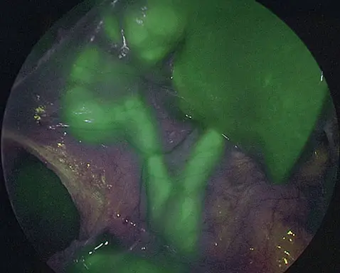 with ICG • Fluorescence-Guided